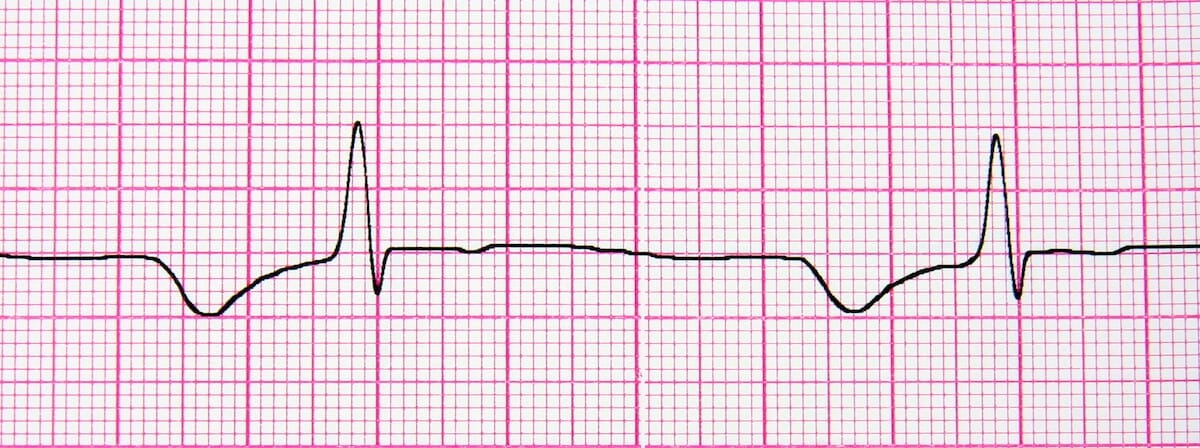 Close up of ecg graph